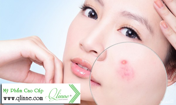 kem-tri-tham-mun-hieu-qua-nhat-1