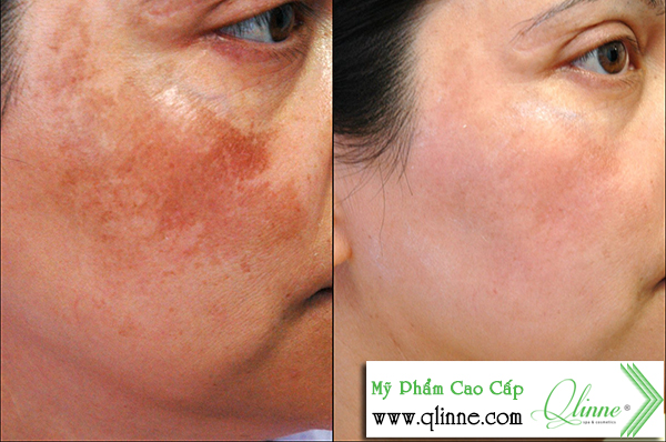 kem-dac-tri-nam-qlinne-1