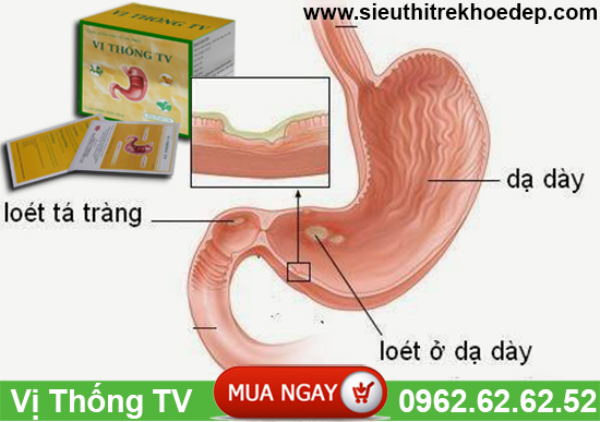 phuong-thuoc-dieu-tri-dut-diem-benh-dau-da-day-kinh-nien-2