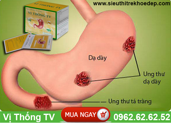 phuong-thuoc-dieu-tri-dut-diem-benh-dau-da-day-kinh-nien-3