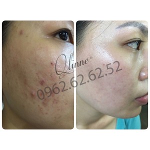 kem-tri-mun-qlinne-smooth-skin-acne-1
