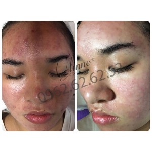 kem-tri-mun-qlinne-smooth-skin-acne-2