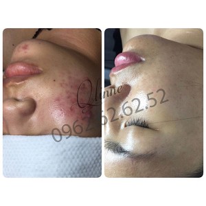 kem-tri-mun-qlinne-smooth-skin-acne-3