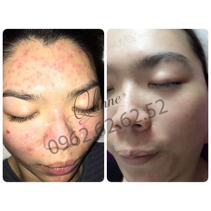 kem-tri-mun-qlinne-smooth-skin-acne-4