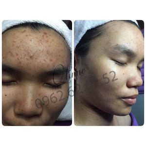 kem-tri-mun-qlinne-smooth-skin-acne-5