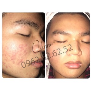 kem-tri-mun-qlinne-smooth-skin-acne-6