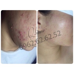 kem-tri-mun-qlinne-smooth-skin-acne-7
